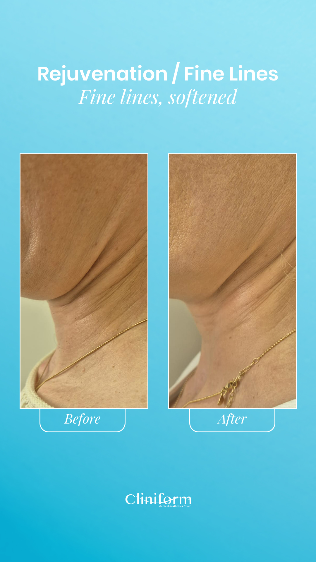 Rejuvenation Fine Lines before and after