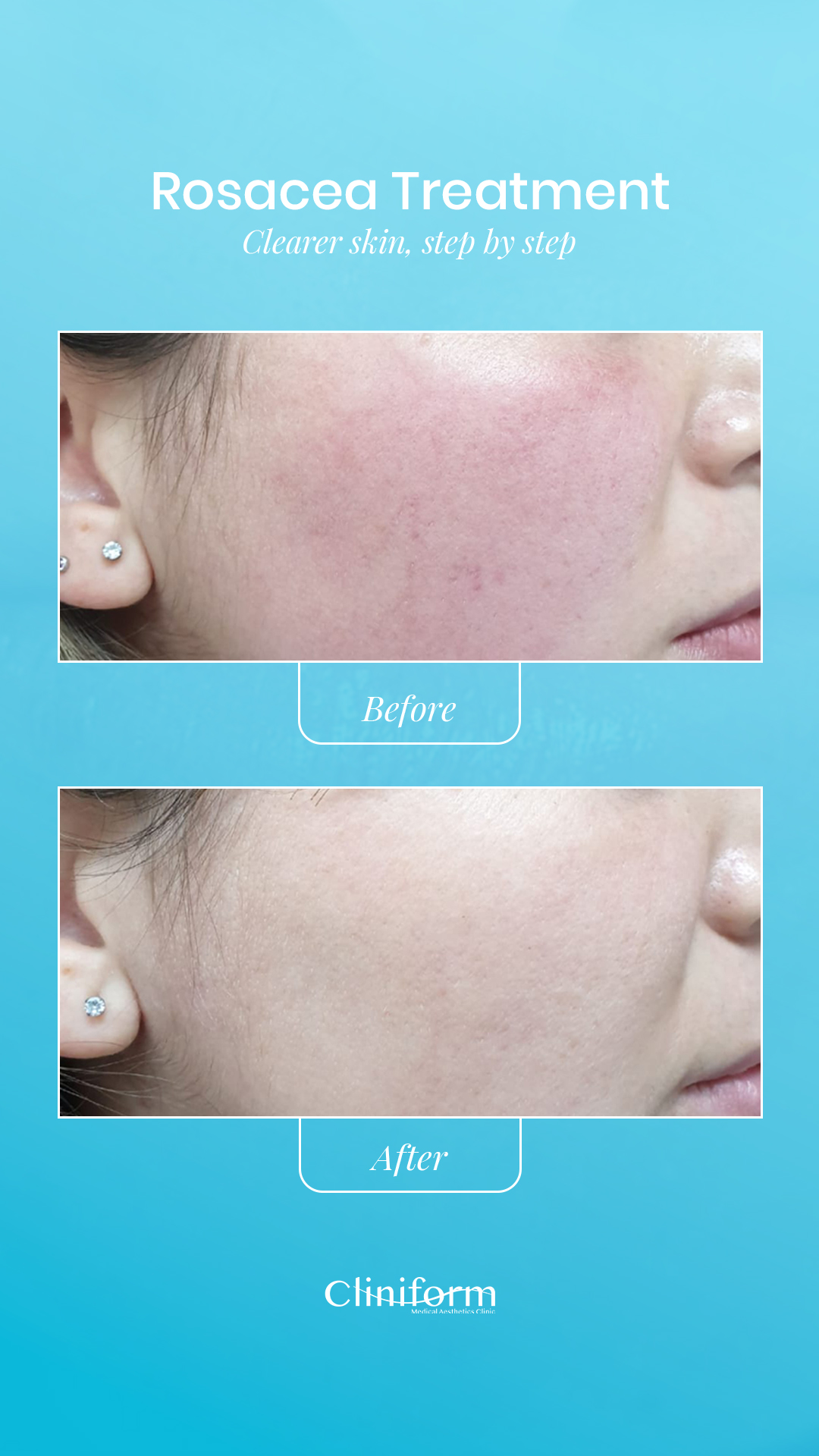 Rosacea Treatment before and after