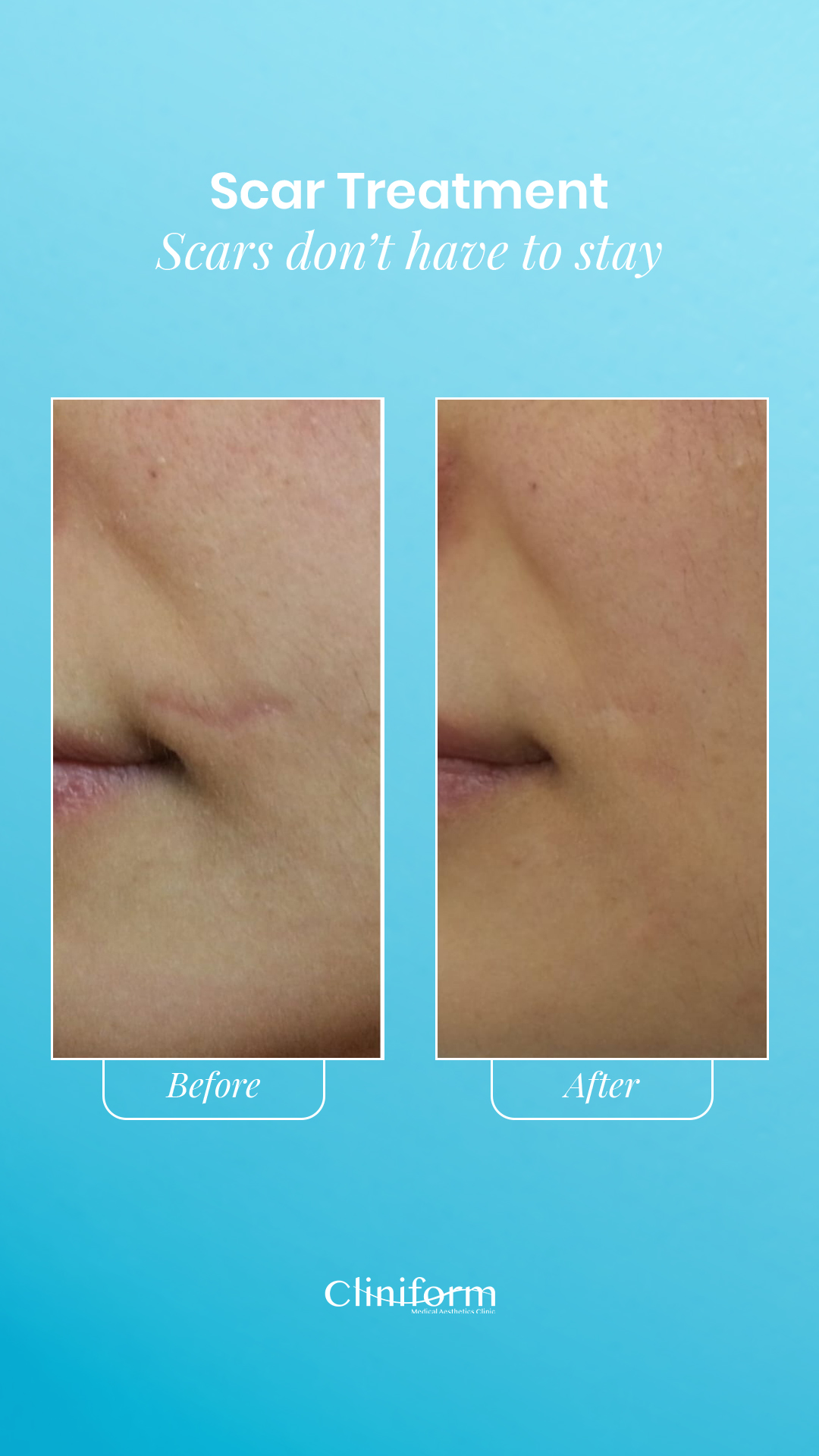 Scar Treatment before and after