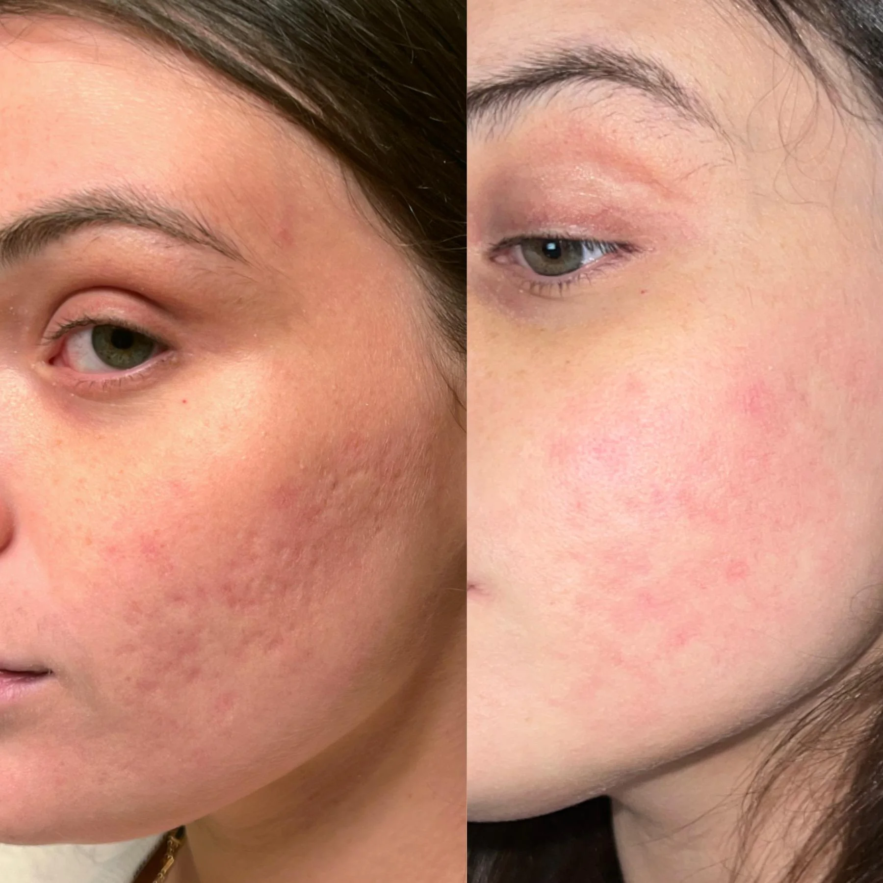 review-i-had-co2-fractional-laser-and-here-is-my-honest-v0-6o3lz0s4khya1.jpg